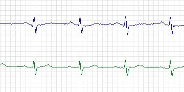 Electrocardiogram for MIT-BIH ECG Compression Test, record 11950_02