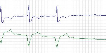 Electrocardiogram for MIT-BIH ECG Compression Test, record 12621_02