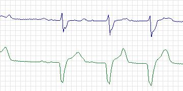 Electrocardiogram for MIT-BIH ECG Compression Test, record 12621_03