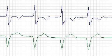 Electrocardiogram for MIT-BIH ECG Compression Test, record 12621_04