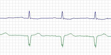 Electrocardiogram for MIT-BIH ECG Compression Test, record 12713_01