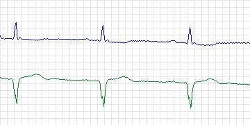 Electrocardiogram for MIT-BIH ECG Compression Test, record 12713_02