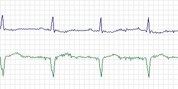 Electrocardiogram for MIT-BIH ECG Compression Test, record 12713_03