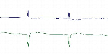 Electrocardiogram for MIT-BIH ECG Compression Test, record 12713_04