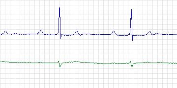 Electrocardiogram for MIT-BIH ECG Compression Test, record 12921_01