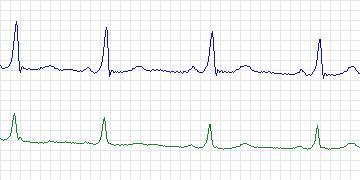Electrocardiogram for MIT-BIH ECG Compression Test, record 12936_01