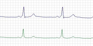 Electrocardiogram for MIT-BIH ECG Compression Test, record 12936_02