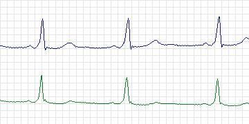 Electrocardiogram for MIT-BIH ECG Compression Test, record 12936_03
