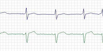 Electrocardiogram for MIT-BIH ECG Compression Test, record 12940_01