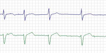 Electrocardiogram for MIT-BIH ECG Compression Test, record 12940_02