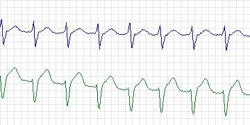 Electrocardiogram for MIT-BIH ECG Compression Test, record 12940_03