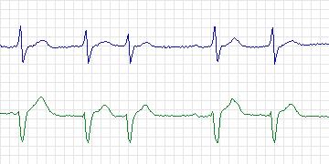Electrocardiogram for MIT-BIH ECG Compression Test, record 12940_04