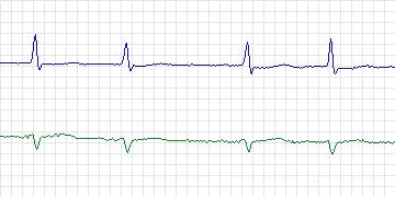 Electrocardiogram for MIT-BIH ECG Compression Test, record 13030_03