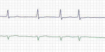 Electrocardiogram for MIT-BIH ECG Compression Test, record 13030_04