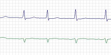 Electrocardiogram for MIT-BIH ECG Compression Test, record 13030_05