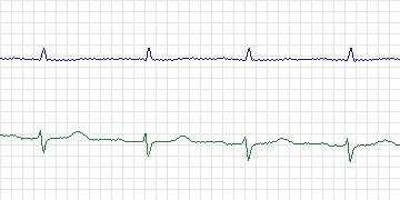 Electrocardiogram for MIT-BIH ECG Compression Test, record 13045_01