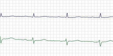 Electrocardiogram for MIT-BIH ECG Compression Test, record 13045_02