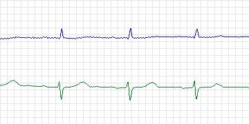 Electrocardiogram for MIT-BIH ECG Compression Test, record 13045_03