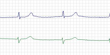 Electrocardiogram for MIT-BIH ECG Compression Test, record 13059_01