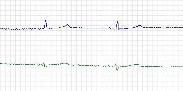 Electrocardiogram for MIT-BIH ECG Compression Test, record 13059_02