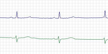 Electrocardiogram for MIT-BIH ECG Compression Test, record 13059_03