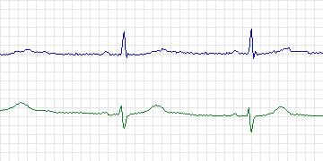 Electrocardiogram for MIT-BIH ECG Compression Test, record 13059_04