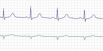 Electrocardiogram for MIT-BIH ECG Compression Test, record 13227_03