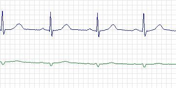 Electrocardiogram for MIT-BIH ECG Compression Test, record 13227_04