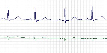 Electrocardiogram for MIT-BIH ECG Compression Test, record 13227_05