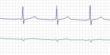 Electrocardiogram for MIT-BIH ECG Compression Test, record 13227_06