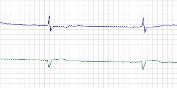 Electrocardiogram for MIT-BIH ECG Compression Test, record 13420_02