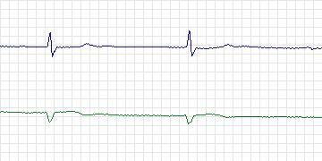 Electrocardiogram for MIT-BIH ECG Compression Test, record 13420_03