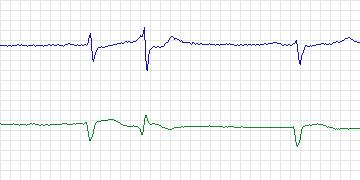 Electrocardiogram for MIT-BIH ECG Compression Test, record 13420_04