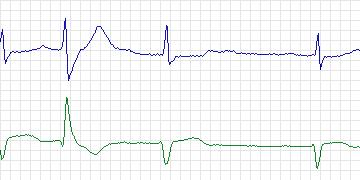 Electrocardiogram for MIT-BIH ECG Compression Test, record 13420_05