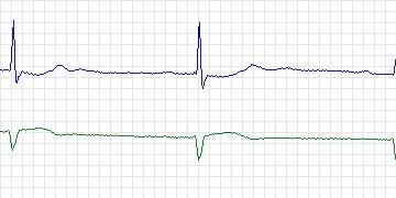 Electrocardiogram for MIT-BIH ECG Compression Test, record 13420_06