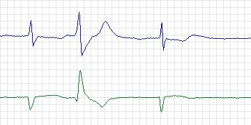 Electrocardiogram for MIT-BIH ECG Compression Test, record 13420_07