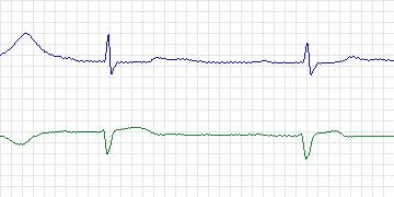 Electrocardiogram for MIT-BIH ECG Compression Test, record 13420_08