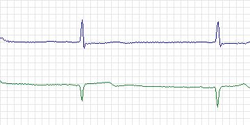 Electrocardiogram for MIT-BIH ECG Compression Test, record 13431_03