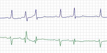 Electrocardiogram for MIT-BIH ECG Compression Test, record 13543_02