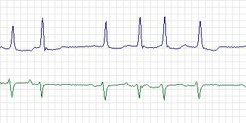 Electrocardiogram for MIT-BIH ECG Compression Test, record 13543_03
