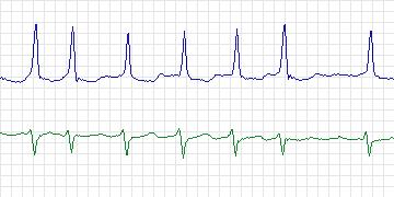 Electrocardiogram for MIT-BIH ECG Compression Test, record 13543_04