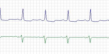 Electrocardiogram for MIT-BIH ECG Compression Test, record 13543_05