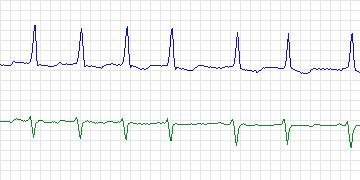Electrocardiogram for MIT-BIH ECG Compression Test, record 13543_06