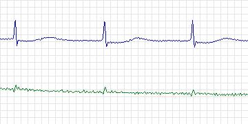 Electrocardiogram for MIT-BIH ECG Compression Test, record 13556_01