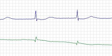 Electrocardiogram for MIT-BIH ECG Compression Test, record 13556_02