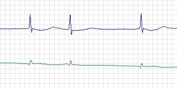 Electrocardiogram for MIT-BIH ECG Compression Test, record 13556_03