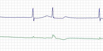 Electrocardiogram for MIT-BIH ECG Compression Test, record 13556_04