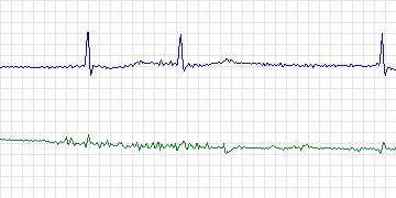 Electrocardiogram for MIT-BIH ECG Compression Test, record 13556_05