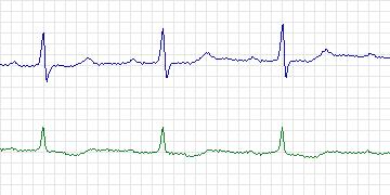 Electrocardiogram for MIT-BIH ECG Compression Test, record 13580_01
