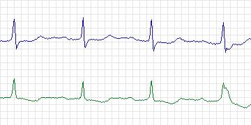 Electrocardiogram for MIT-BIH ECG Compression Test, record 13580_02